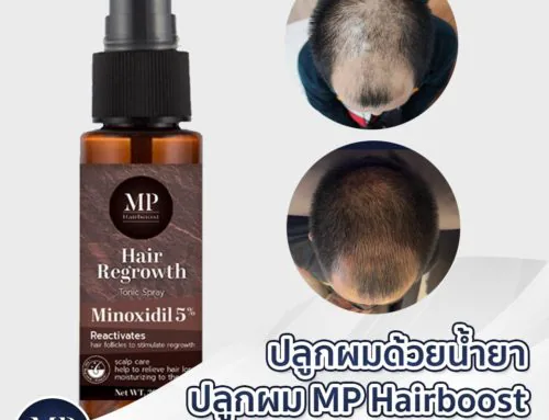 ปลูกผมด้วยน้ำยา MP Hairboots