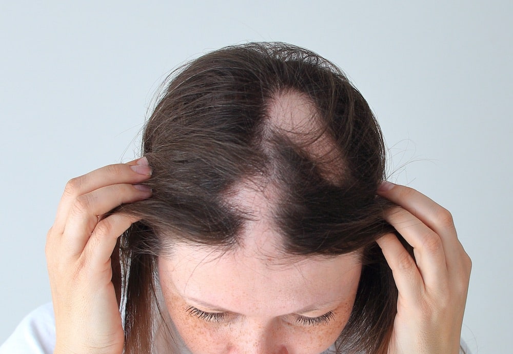Alopecia-Areata-min