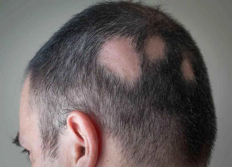 Alopecia-Areata-www