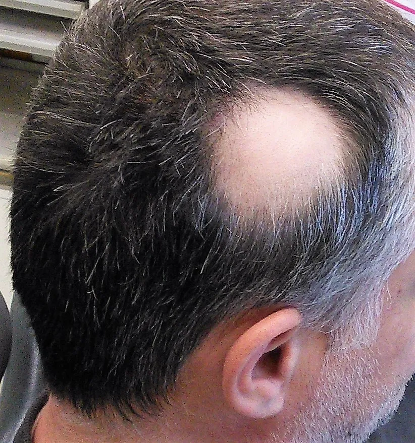 Alopecia_areata_1