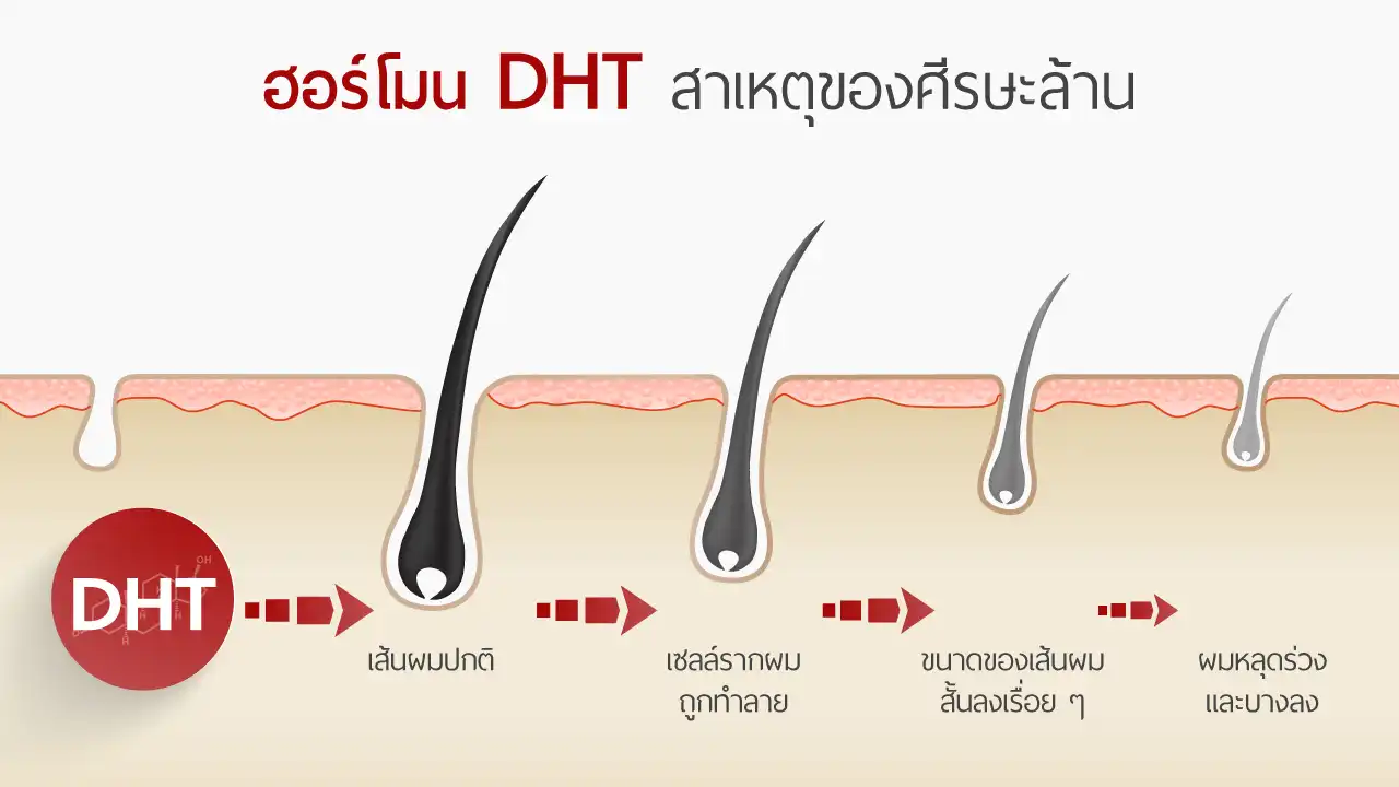 05_0_hair-loss-hormone