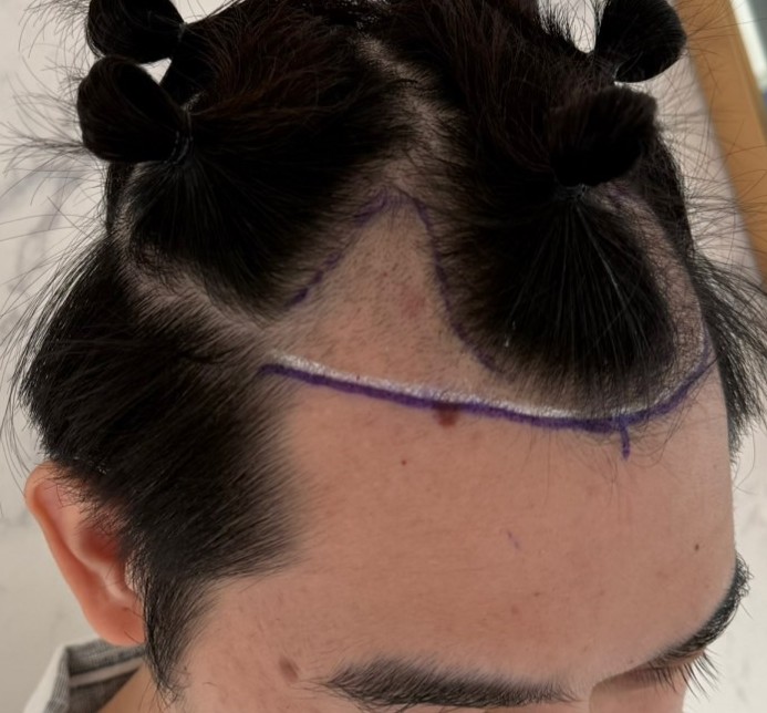 case01-khunb-02-surgery-day-3