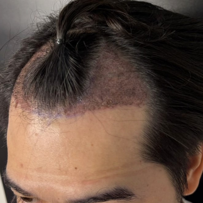 case01-khunb-03-after-immediate-1