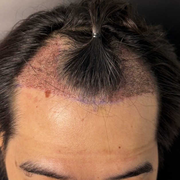 case01-khunb-03-after-immediate-2