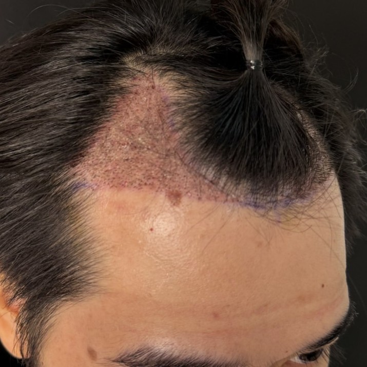 case01-khunb-03-after-immediate-3