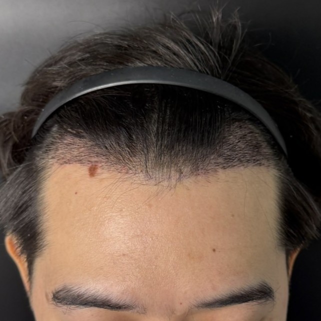 case01-khunb-04-after-14d-2