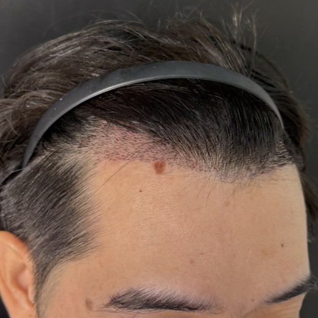 case01-khunb-04-after-14d-3