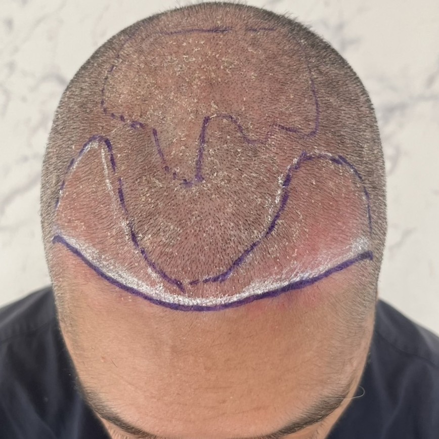 case02-khung-03-surgery-day-2