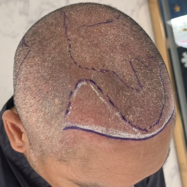 case02-khung-03-surgery-day-3