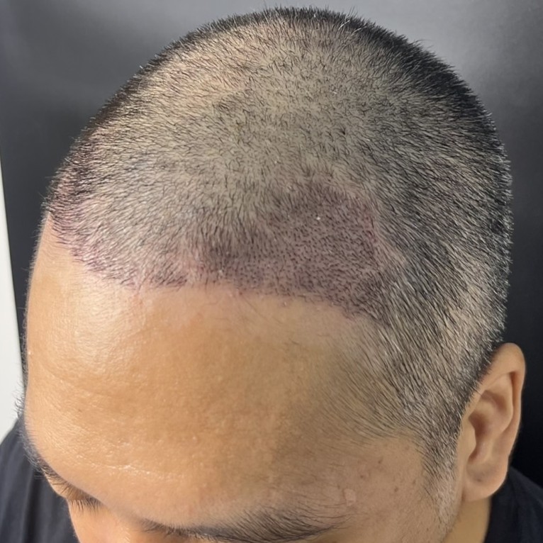 case02-khung-04-after-14d-1
