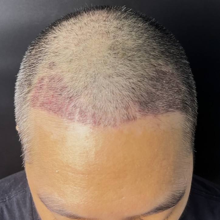 case02-khung-04-after-14d-2
