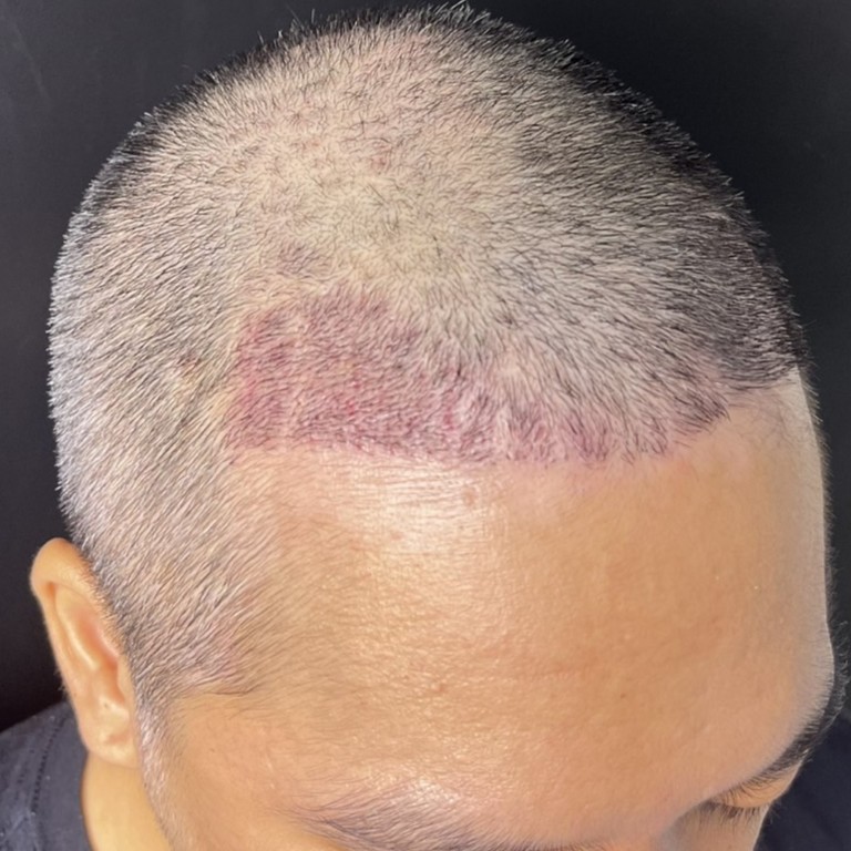 case02-khung-04-after-14d-3