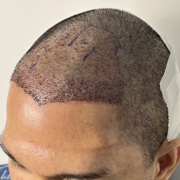 case03-khund-04-after-immediate-1