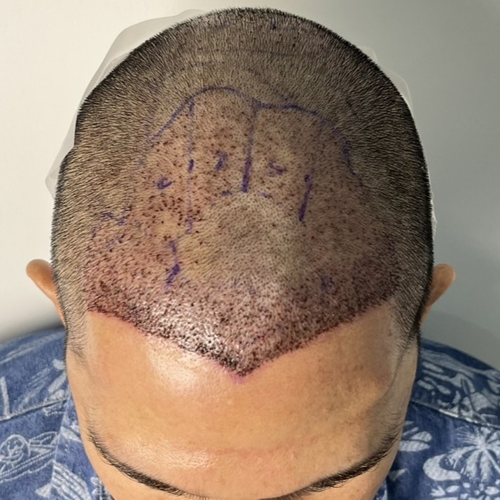case03-khund-04-after-immediate-2