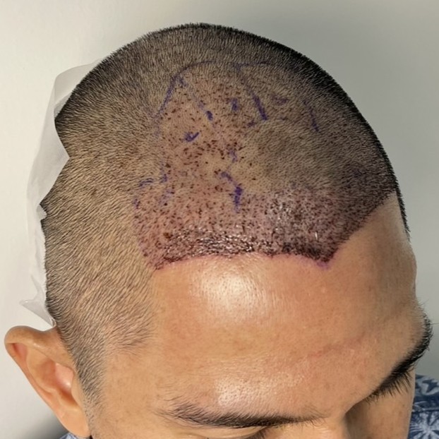 case03-khund-04-after-immediate-3