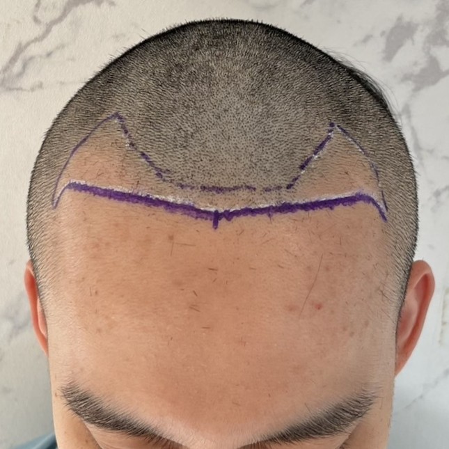 case04-khunv-03-surgery-day-2