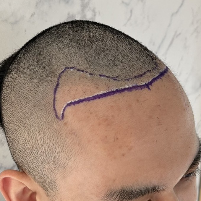 case04-khunv-03-surgery-day-3
