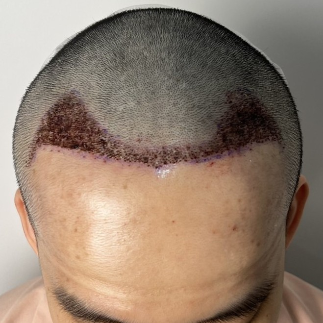 case04-khunv-04-after-immediate-1