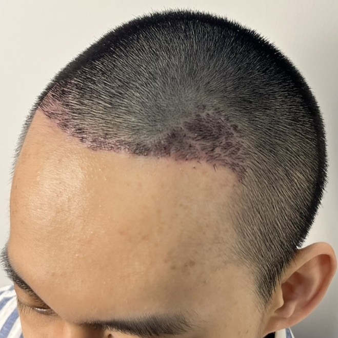 case04-khunv-05-after-14d-1