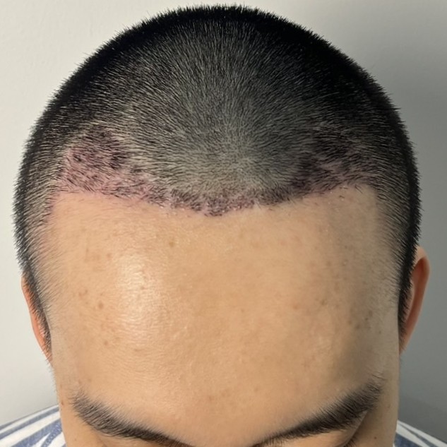 case04-khunv-05-after-14d-2