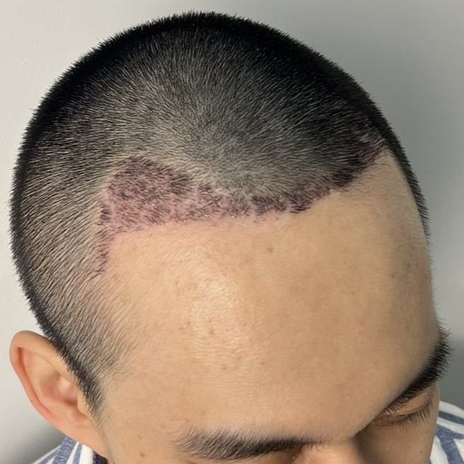 case04-khunv-05-after-14d-3