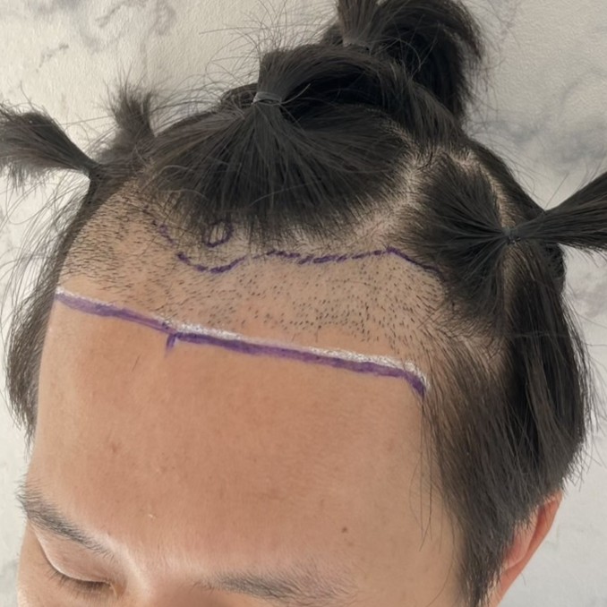 case06-khunk-02-surgery-day-1