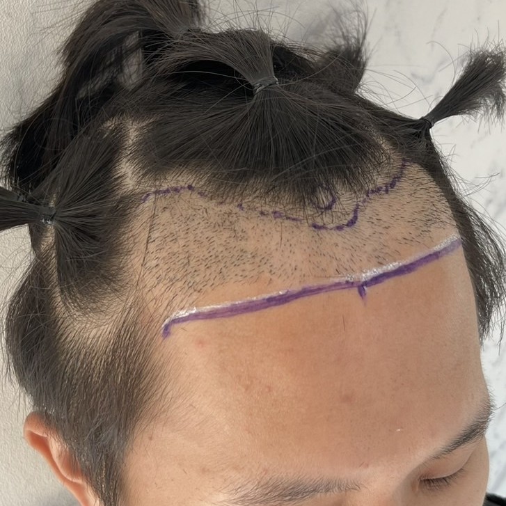 case06-khunk-02-surgery-day-3