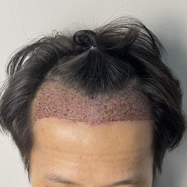 case06-khunk-03-after-immediate-1