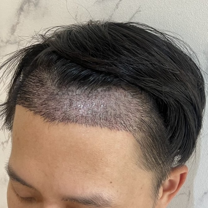 case06-khunk-04-after-14d-1