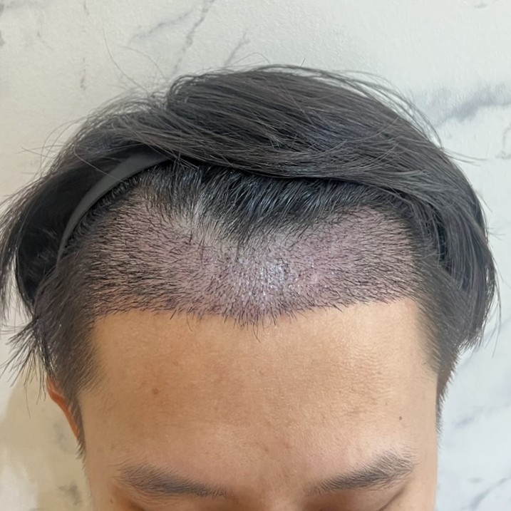 case06-khunk-04-after-14d-2