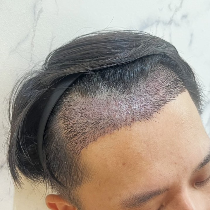 case06-khunk-04-after-14d-3