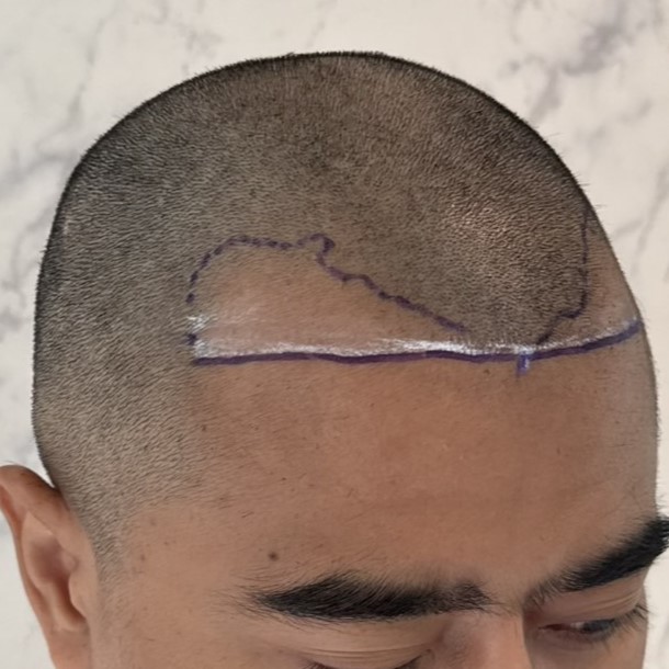 case08-khunf-02-surgery-day-3