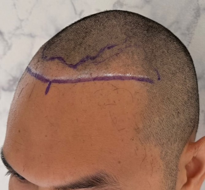 case09-khuns-02-surgery-day-1