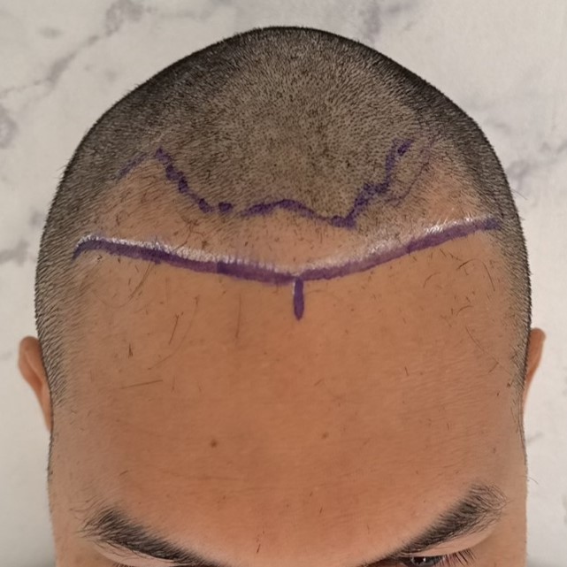 case09-khuns-02-surgery-day-2
