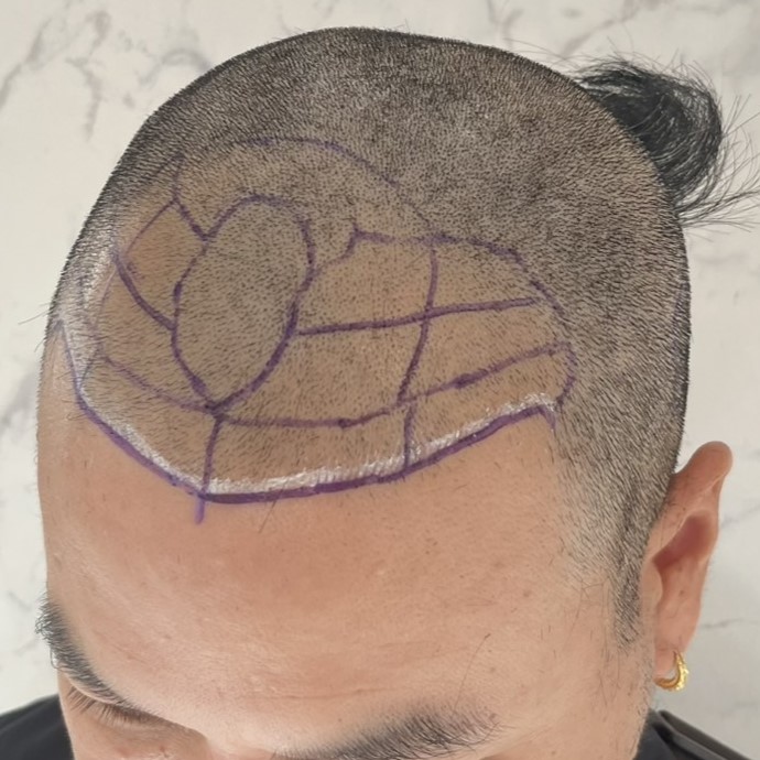 case10-khunka-02-surgery-day-1