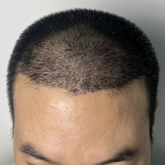 case10-khunka-03-after-14d-2