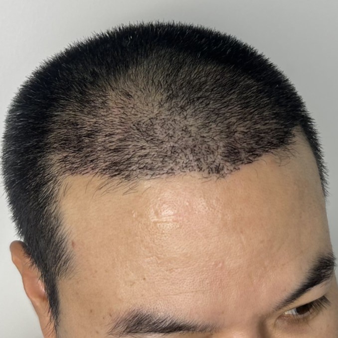 case10-khunka-03-after-14d-3
