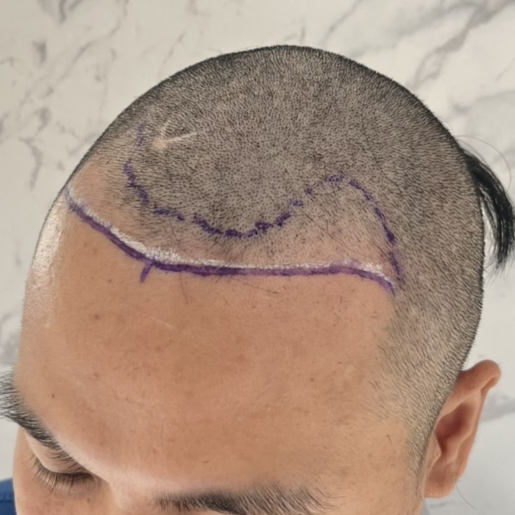 case11-khunbt-02-surgery-day-1