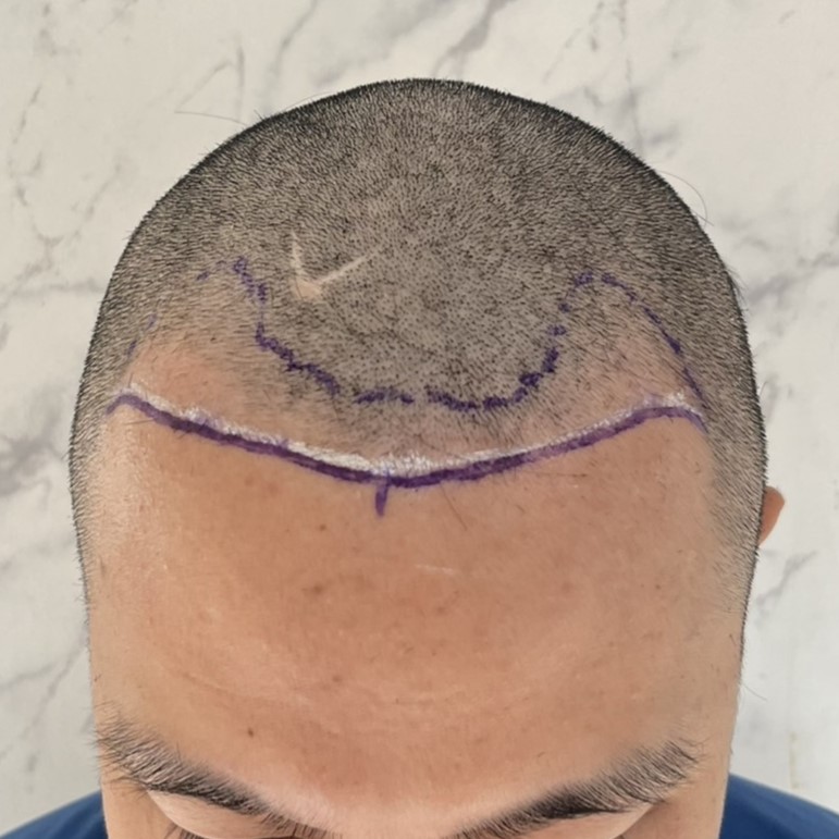 case11-khunbt-02-surgery-day-2