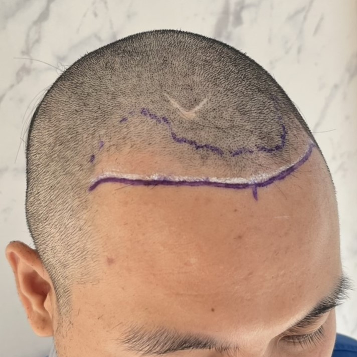 case11-khunbt-02-surgery-day-3