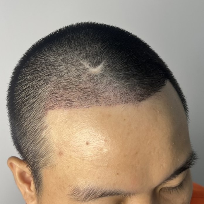 case11-khunbt-03-after-14d-3