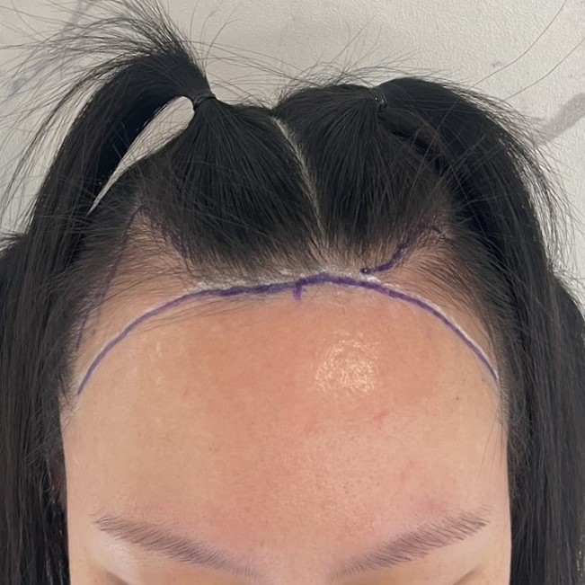 case13-khunp-02-surgery-day-2