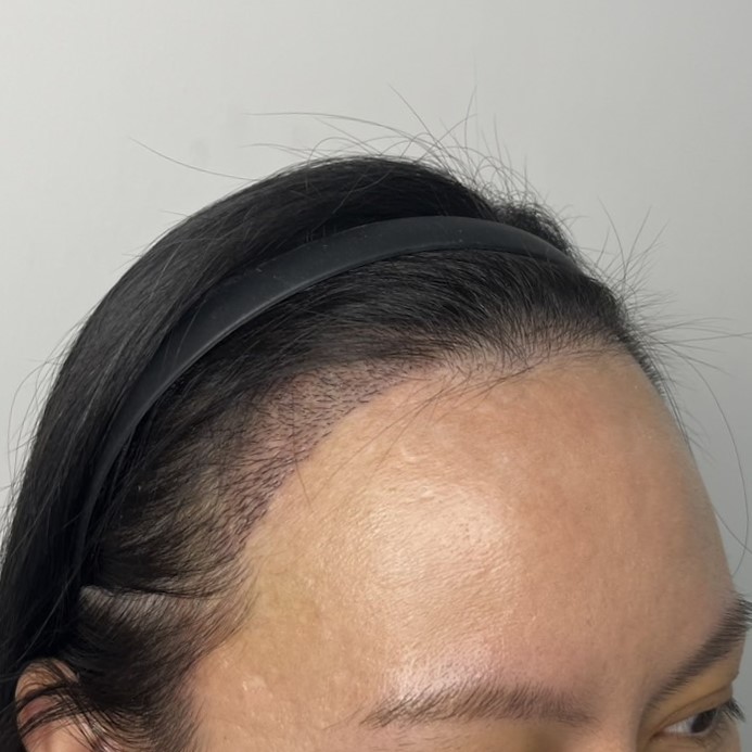 case13-khunp-04-after-14d-3