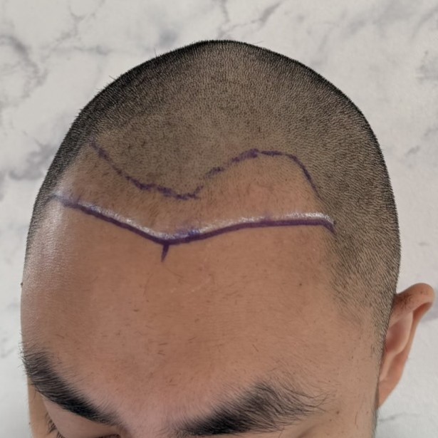 case14-khunpa-02-surgery-day-1