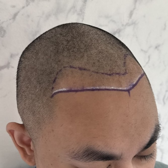 case14-khunpa-02-surgery-day-3