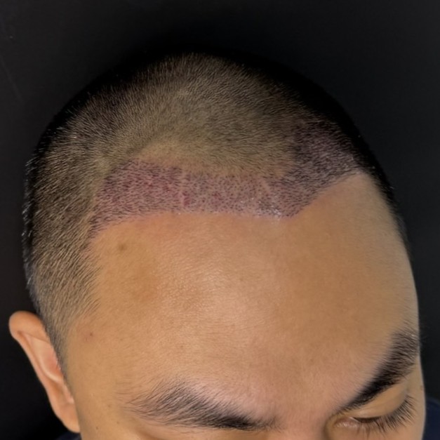 case14-khunpa-04-after-14d-3