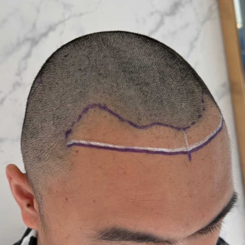 case15-khunjd-02-surgery-day-3