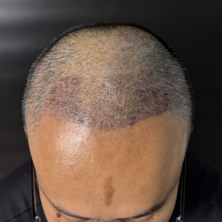 case19-khunam-03-after-14d-2