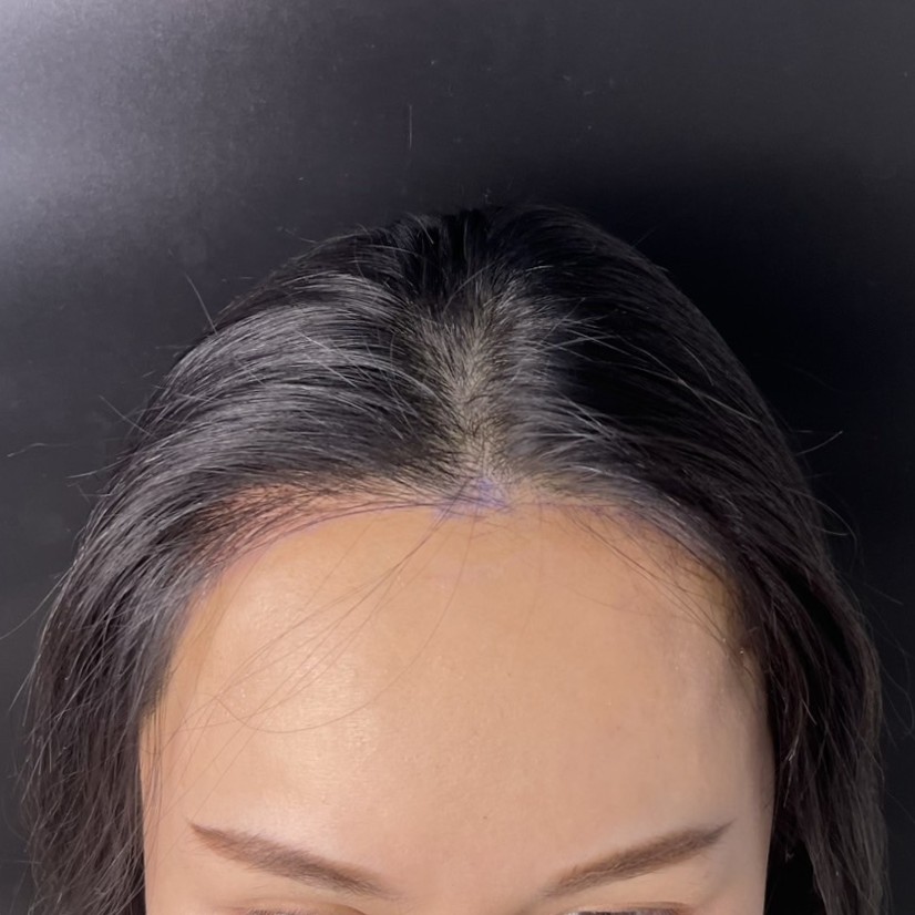 case20-khunpo-02-after-immediate-1
