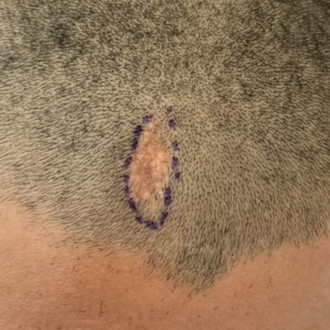 case22-khunts-02-surgery-day-1